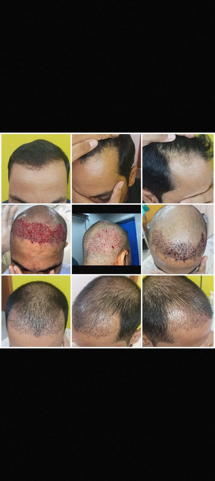 Hair transplant